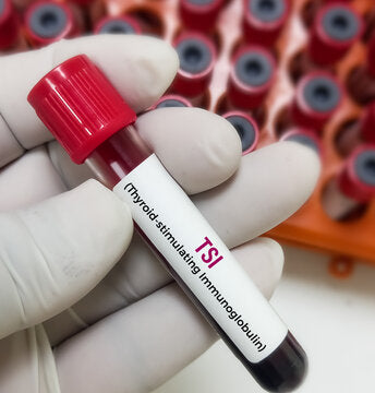 TSI (Thyroid Stimulating Immunoglobulin)